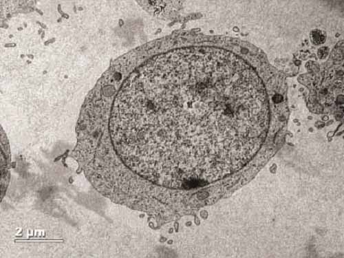 Cells without CD34 (above) lack the tentacle-like extensions (red arrows below) that help cells bind to adhesion molecules in the bone marrow.