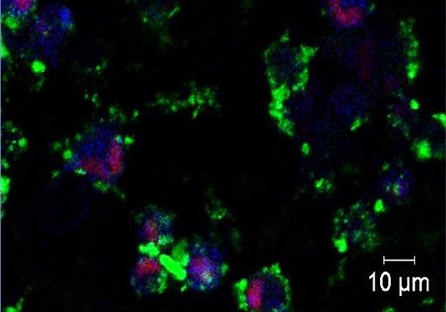 Live cell imaging shows fluorescently labeled targeted ZnO nanoparticles (green) dissolving to release zinc ions (blue) within the intracellular environment of triple-negative breast cancer cells, activating cell death pathways (red).
