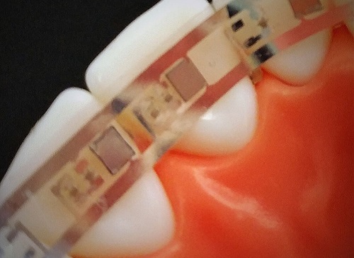 Each tooth has its own near-infrared LEDs to provide localized light therapy.