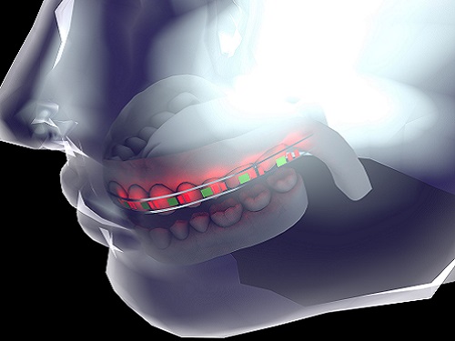 Flexible lithium batteries have been incorporated into dental braces as part of efforts to increase the efficiency of corrective orthodontics.