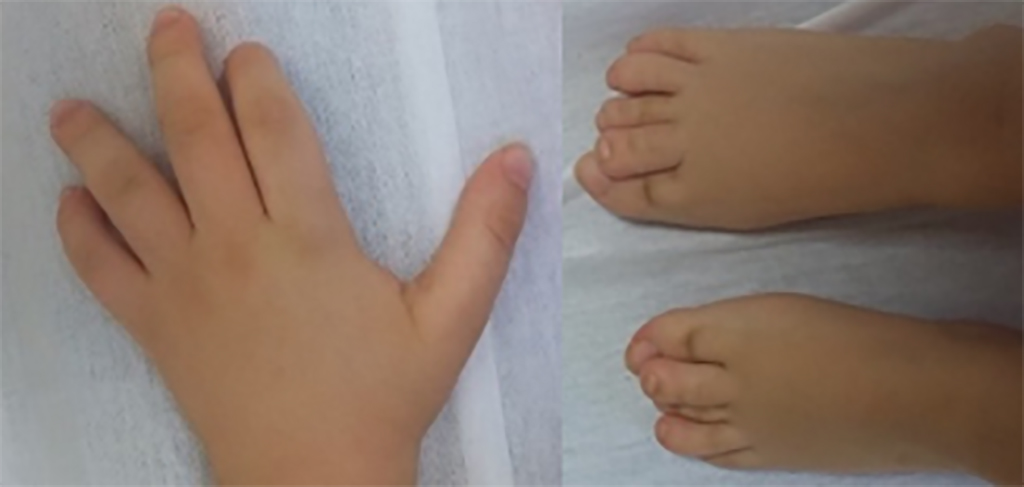The hands and feet of patients with CHEDDA commonly have features that include abnormalities of the palmar creases, bulbous endings to the fingers and toes, and toes that overlap.