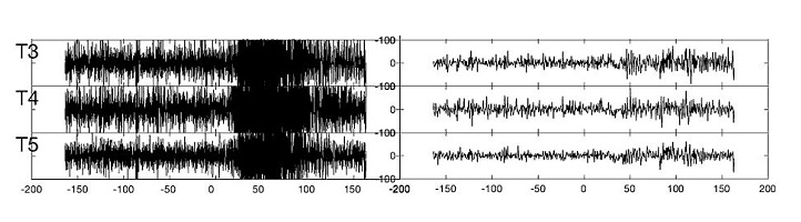The original EEG at the start of a seizure (left) compared to the signal when cleaned from noise (right).