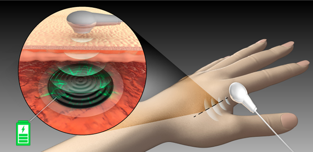 A drug delivery microdevice could be implanted under the skin in lieu of multiple injections. It could be remotely charged using the team's hydrogel.