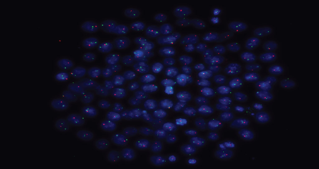 This cell image shows a DNA FISH of an induced pluripotent stem cell (IPSC) colony obtained from a Klinefelter patient stained for X(green) and Y (red) chromosomes in the nuclei (blue).